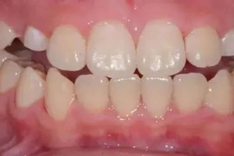 牙结石指数0度图 牙结石指数0度图