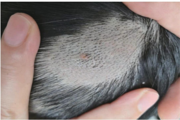 基底样毛囊错构瘤秃发伴丘疹图