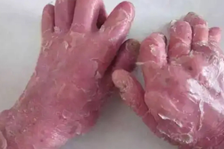 红皮病脱屑期手背脱皮图