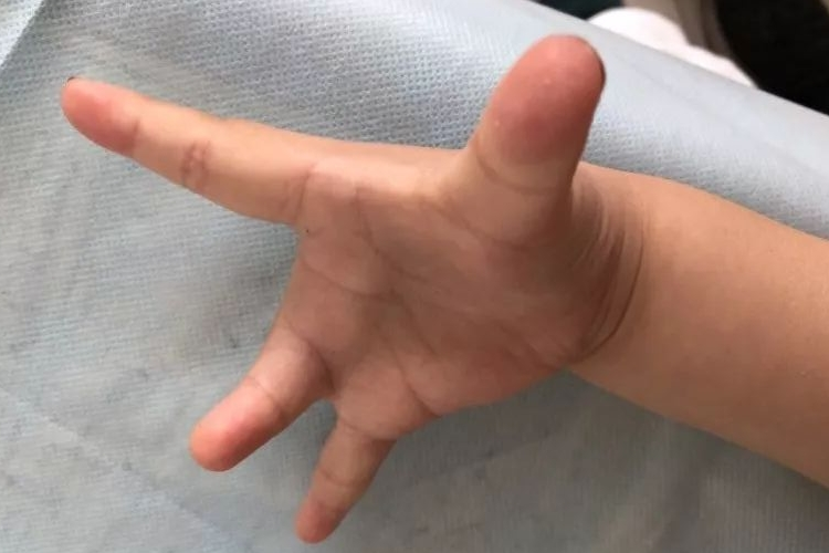 德朗热综合征缺指图