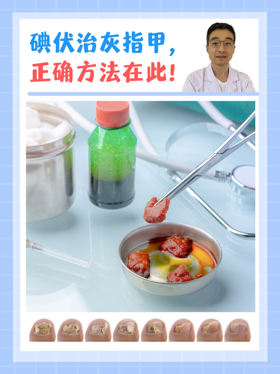 碘伏治灰指甲，正确方法在此！