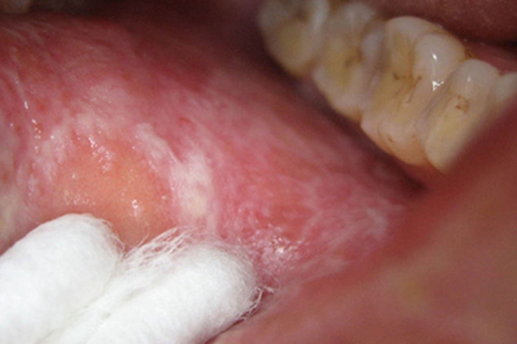 斑块型口腔扁平苔藓白斑图