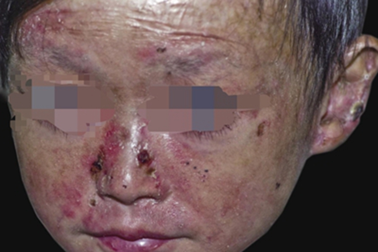 营养不良型大疱性表皮松解症图