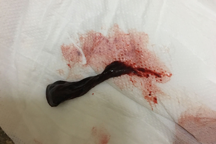 血可表现为阴道有少量暗红褐色的分泌物排出,也可为黑褐色,并有小血块