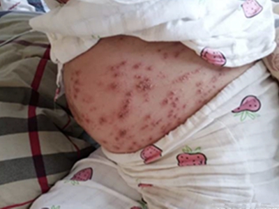 妊娠多形疹肚子上有大面积隆起的红斑图.jpeg