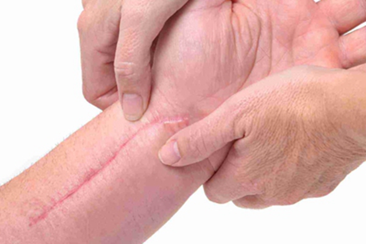 萎缩性瘢痕胳膊瘢痕图