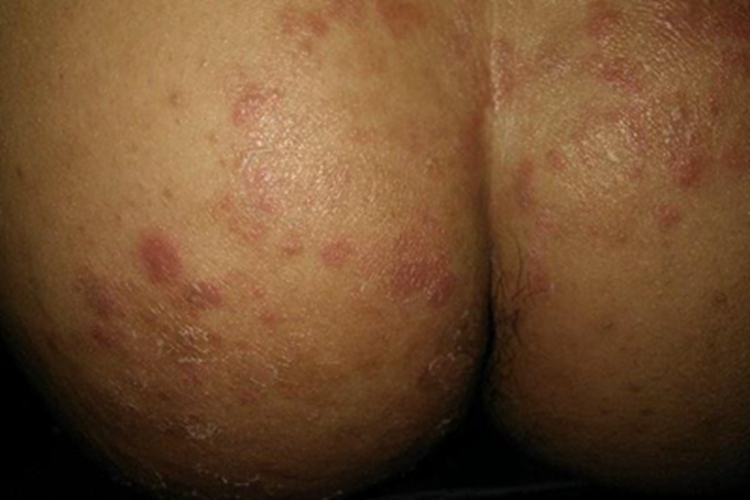 女性结节性梅毒疹臀部结节图