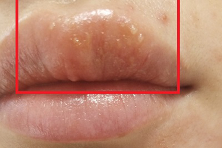 唇炎嘴唇小水疱图