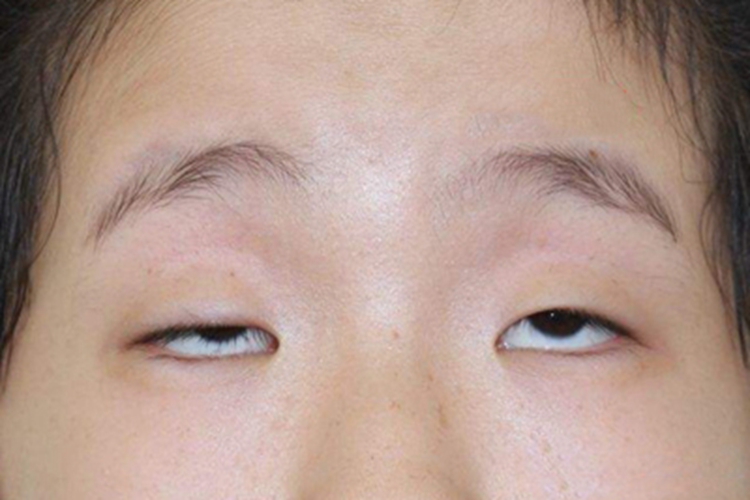 眼睑皮肤松弛症眼睛睁不大图