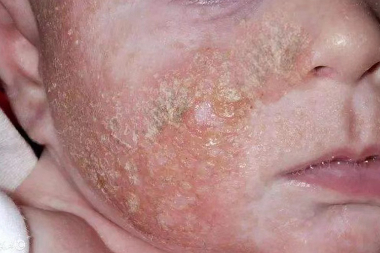 新生儿剥脱性皮炎图 新生儿剥脱性皮炎图