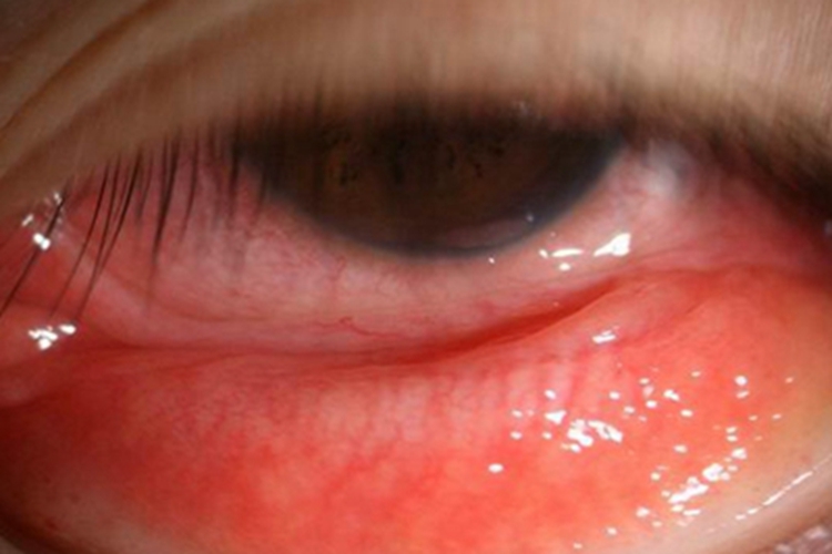 进行期沙眼眼睛充血图 进行期沙眼眼睛充血图