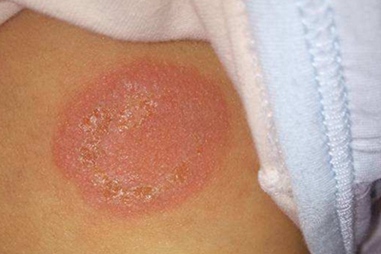 皮肤过敏红肿背部结痂图 皮肤过敏红肿背部结痂图