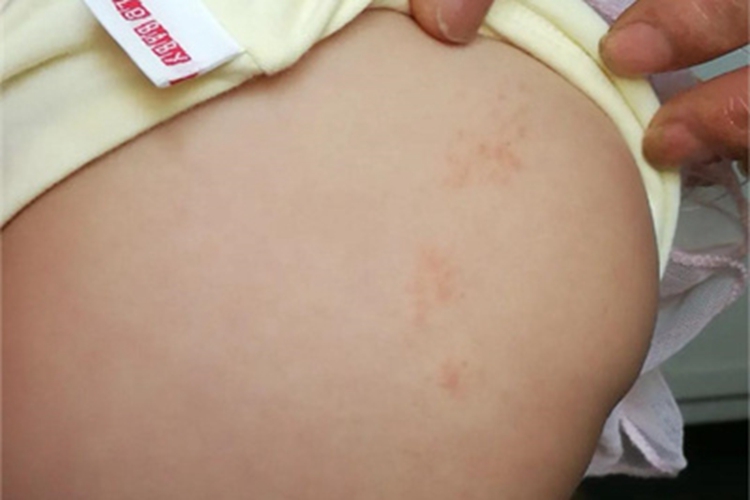 线状苔藓臀部症状图