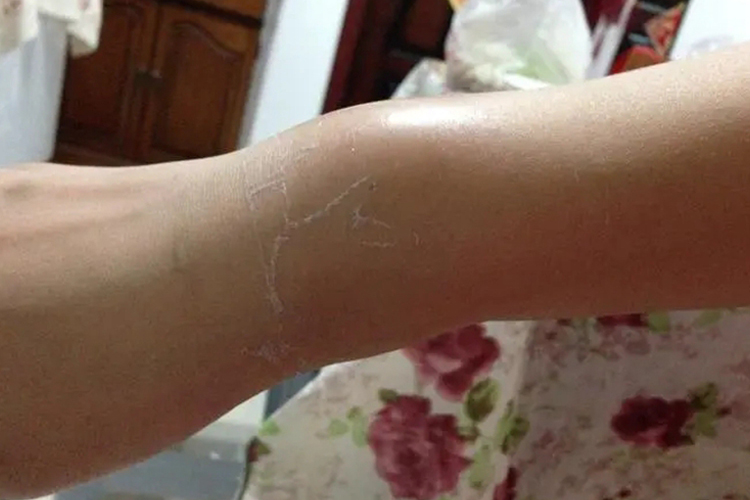 手腕扭伤图 手腕扭伤图