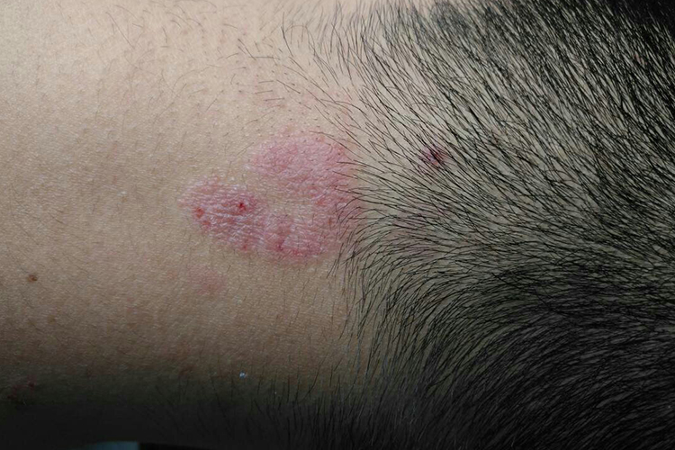 颈部湿疹样变或苔藓样改变图