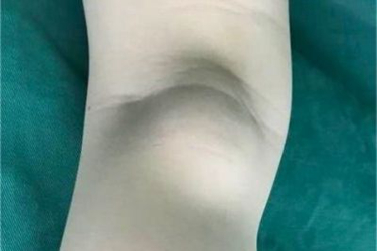 儿童腘窝囊肿大包图 儿童腘窝囊肿大包图