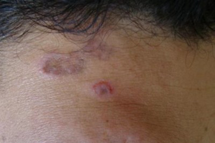 光线性扁平苔藓前额红斑图