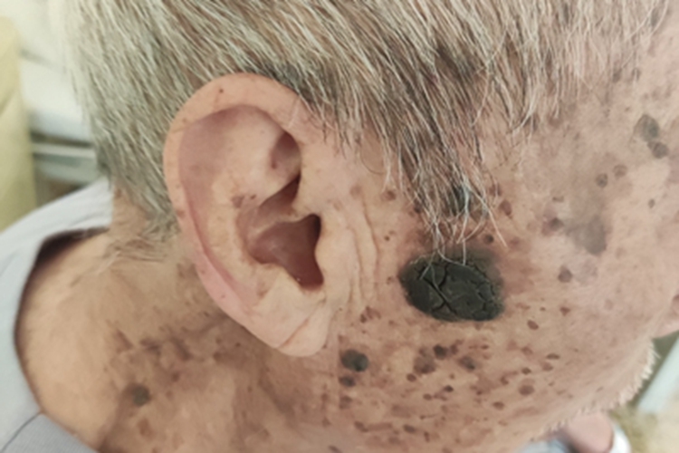 脂溢性角化病面部症状图