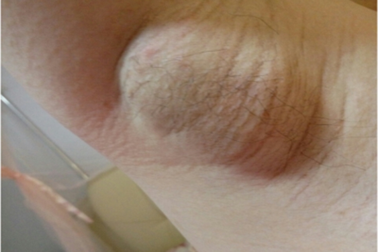 皮脂腺囊肿腋窝大疙瘩图