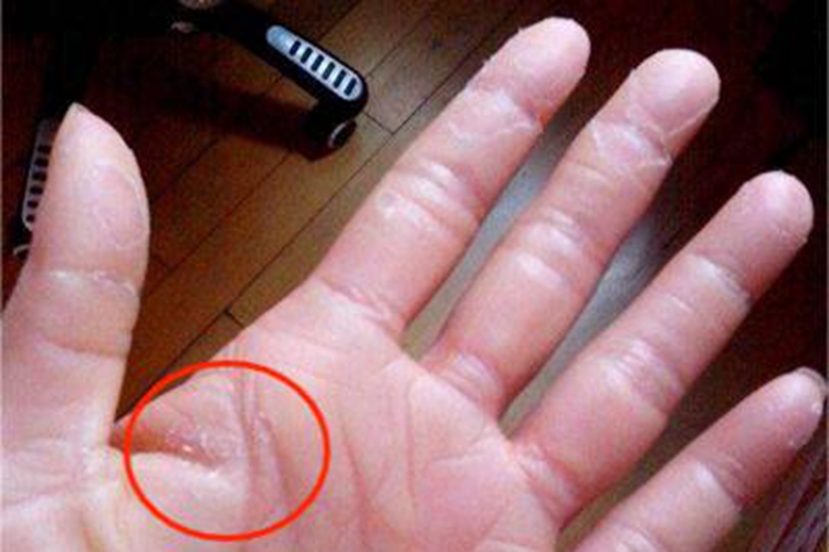 弥漫性掌跖角化病手心脱皮图 弥漫性掌跖角化病手心脱皮图