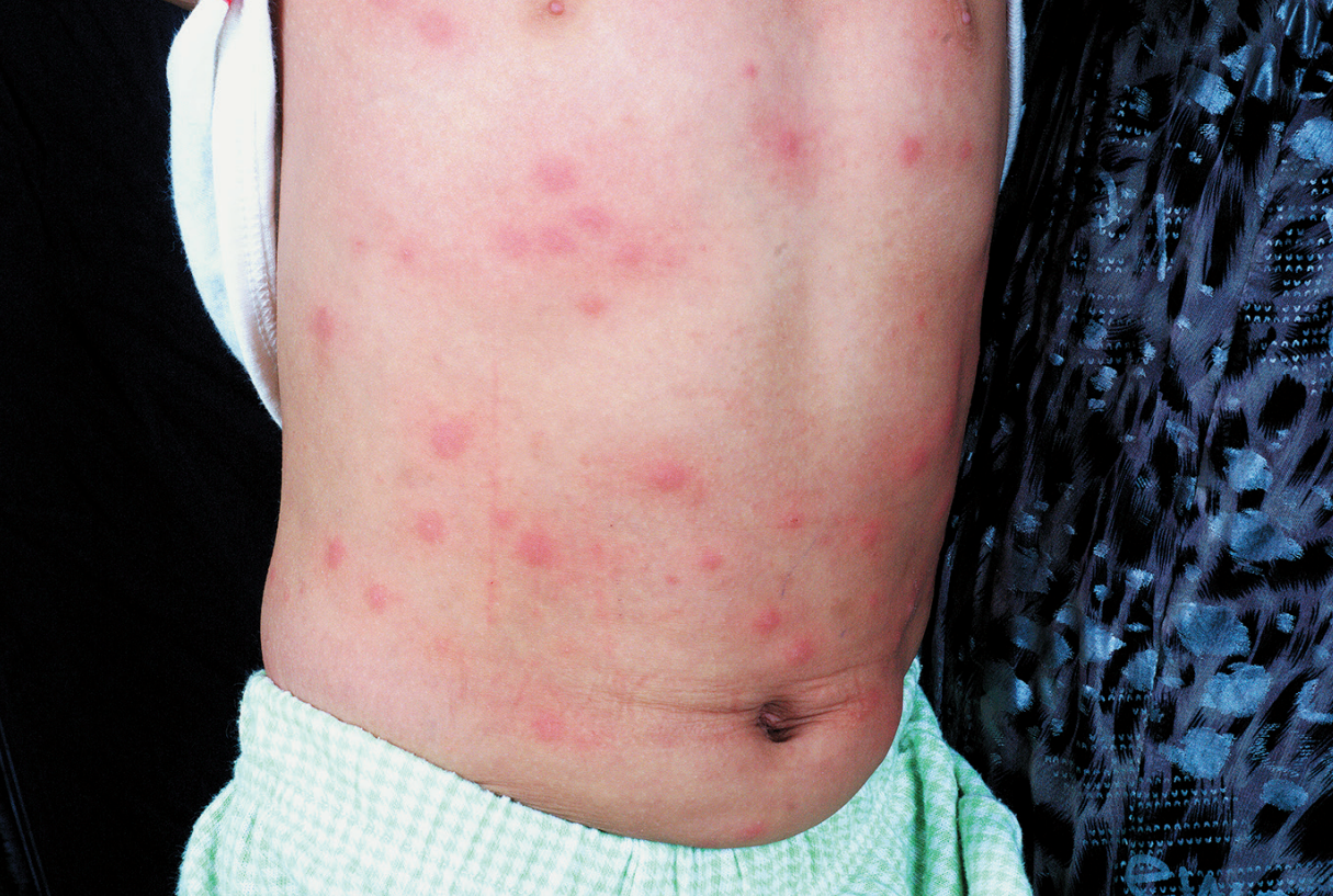 男性丘疹性荨麻疹图