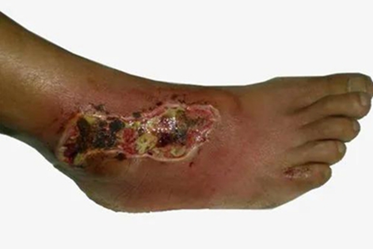 三度烫伤脚踝症状图 三度烫伤脚踝症状图