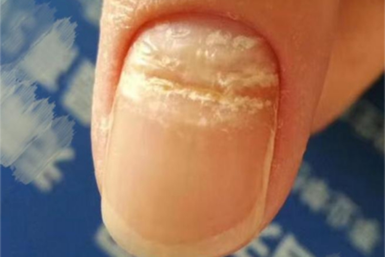 近端甲下型甲真菌病手指甲症状图
