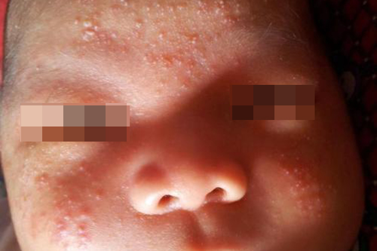新生儿脸上汗疱疹图