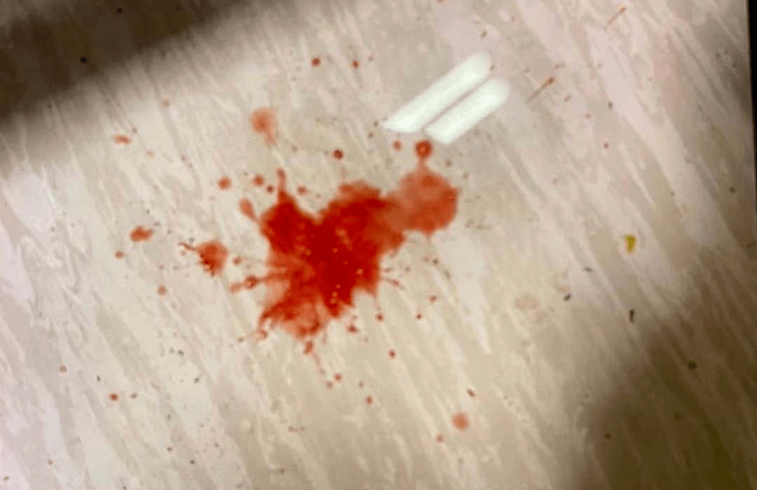 腹型过敏性紫癜呕血图