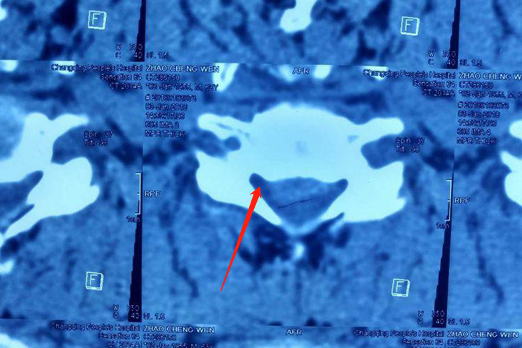 脊髓型颈椎病CT图