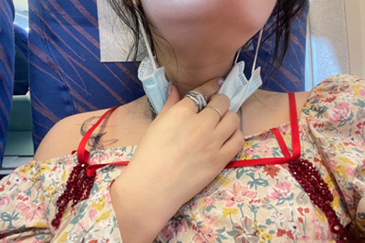 慢性颌下腺炎肿块图