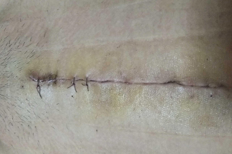 卵巢癌开腹术式纵行刀口图 卵巢癌开腹术式纵行刀口图