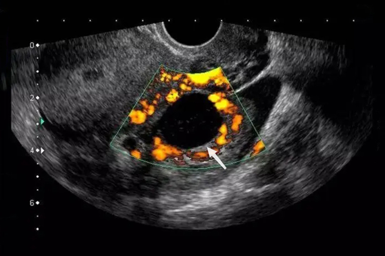 黄体囊肿卵巢包块图