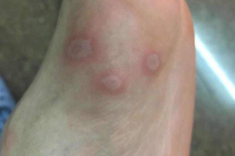 大人手足口病脚部症状图