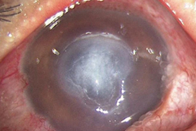 细菌性角膜炎眼球白斑图