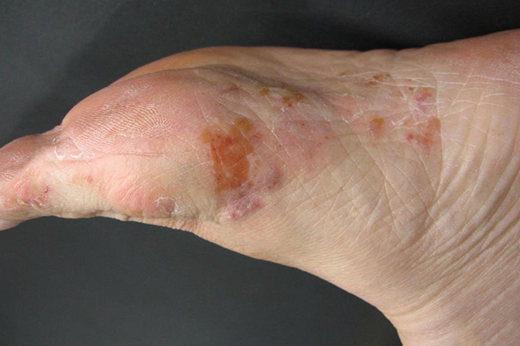 水疱型足癣图