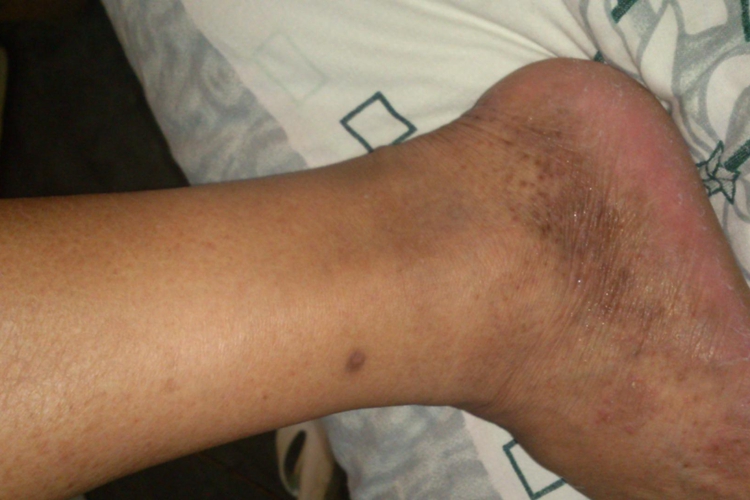 日光性皮炎脚部长斑图