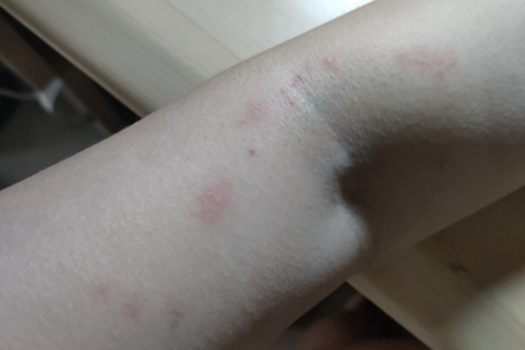 亚急性接触性皮炎胳膊红斑图