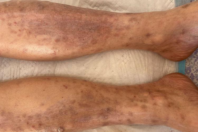 慢性湿疹图 慢性湿疹图