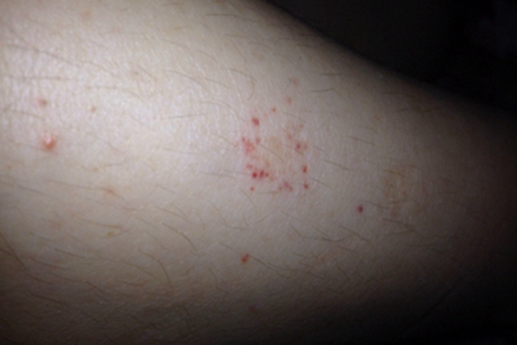 单纯性紫癜腿上出血点图 单纯性紫癜腿上出血点图