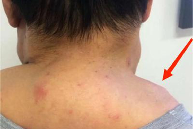 脂肪瘤肩部结节图 脂肪瘤肩部结节图