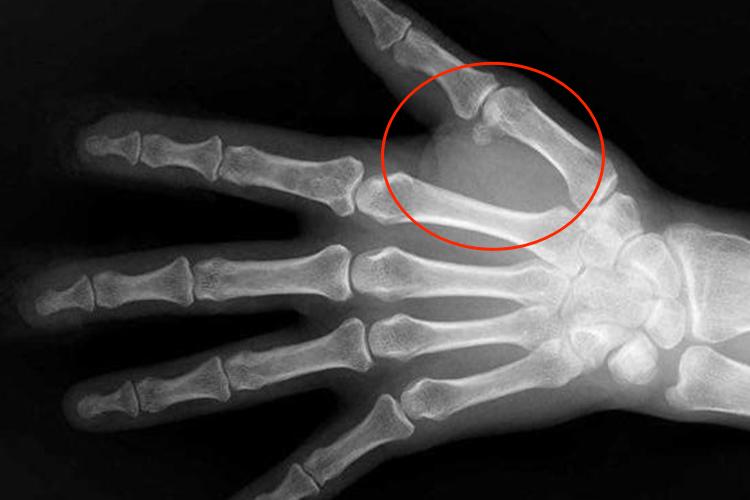 软骨瘤X线影像图