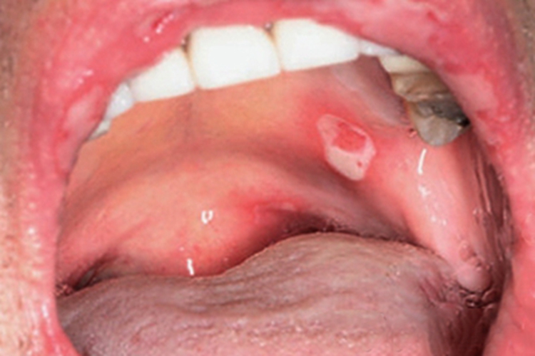 副肿瘤性天疱疮口腔症状图