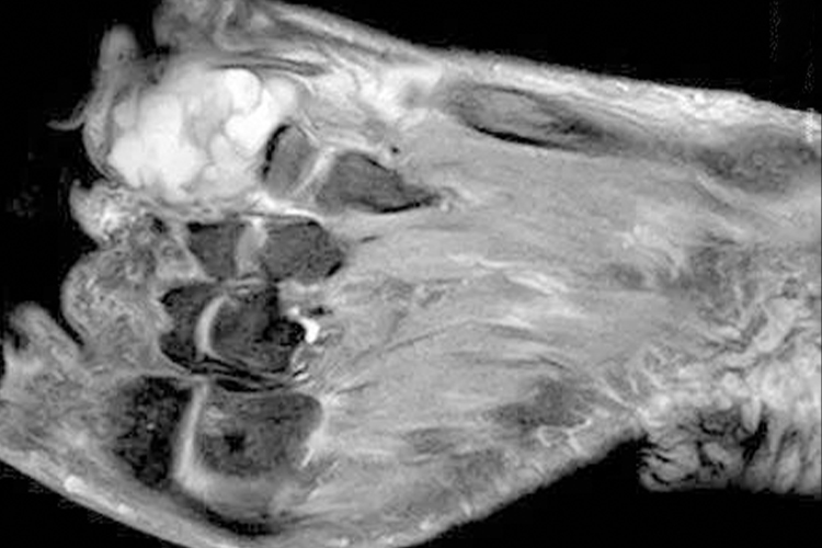 甲下骨疣X线图 甲下骨疣X线图