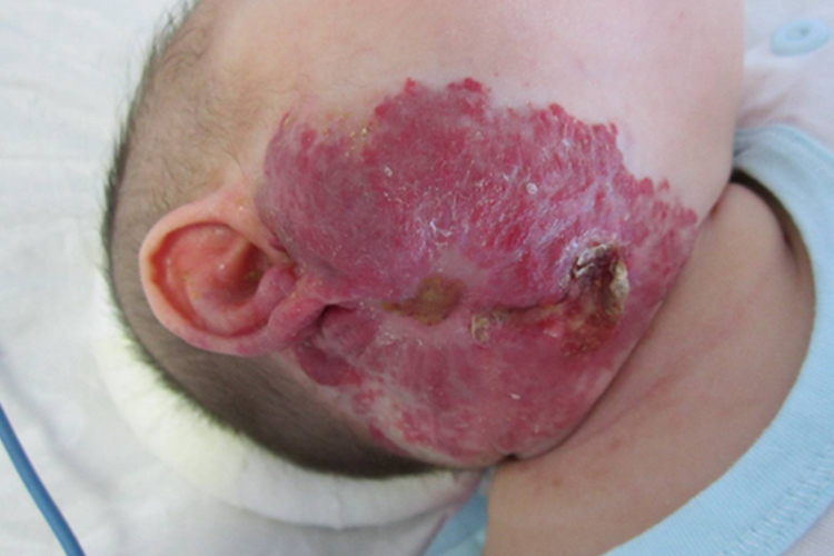 婴儿颈部海绵状血管瘤图