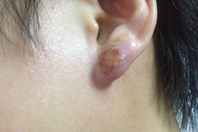 外耳湿疹耳廓发红流脓图