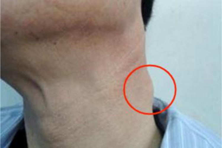 急性化脓性扁桃体炎下巴症状图 急性化脓性扁桃体炎下巴症状图