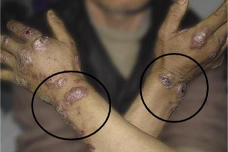 持久性隆起性红斑手腕症状图