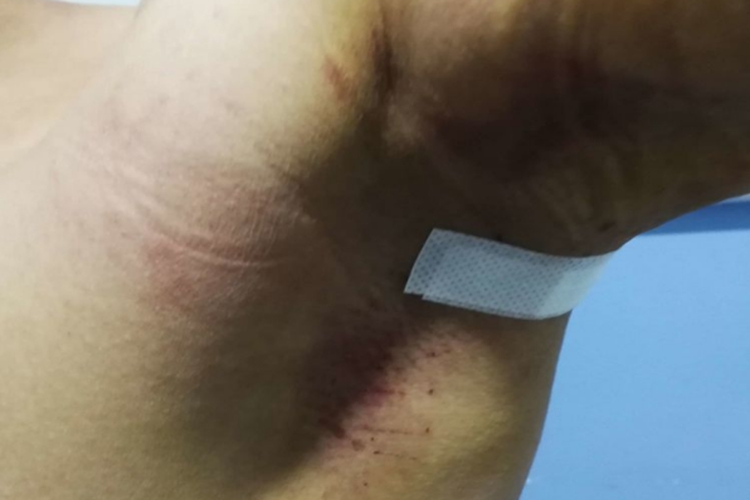 小切口匙刮术术后一周图 小切口匙刮术术后一周图