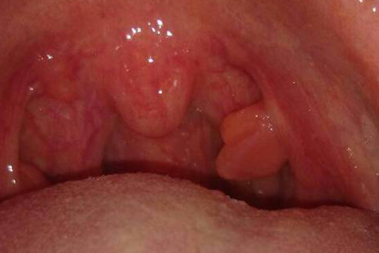 扁桃体息肉图